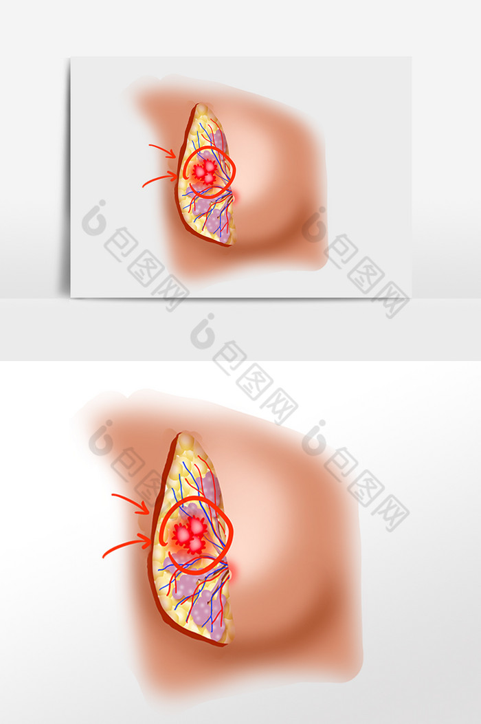 乳房肿瘤乳腺疾病图片图片