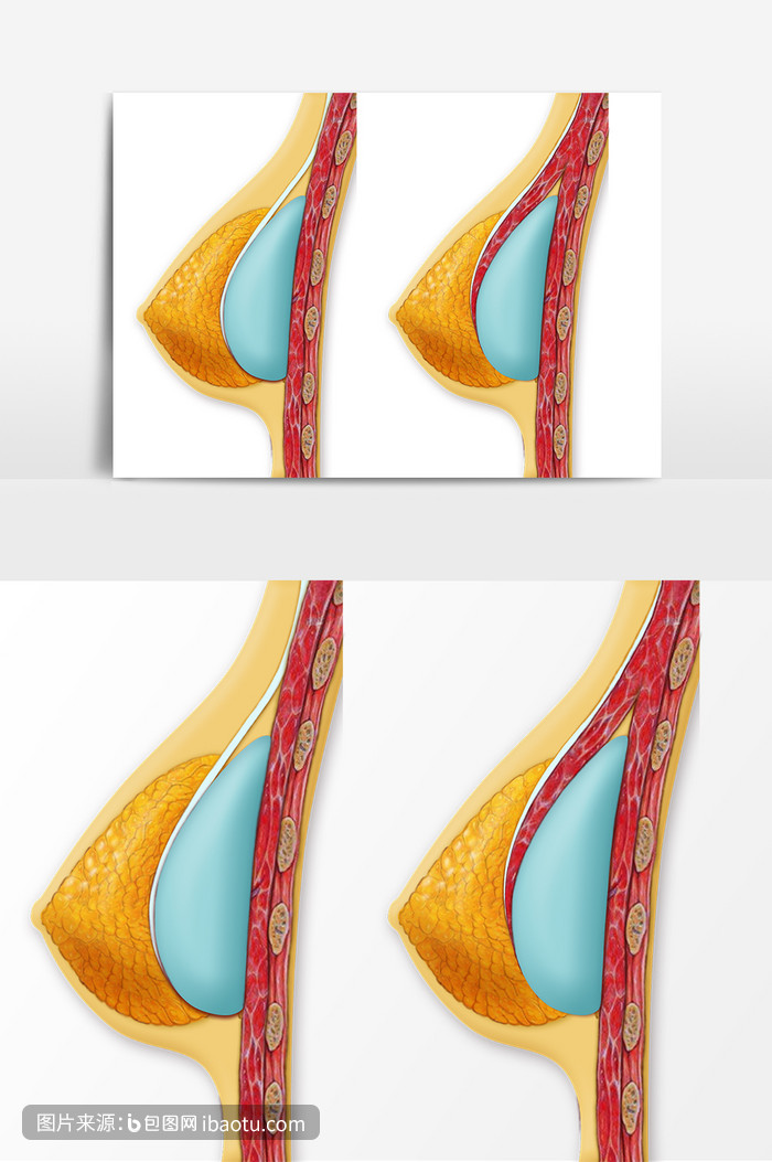 医疗美容假体隆胸示意图,包图网,图片,素材,模板,免费