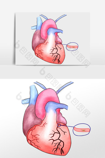 人体内脏心梗疾病图片