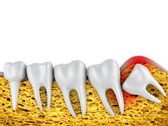 牙科排磨牙和不正确定位智齿。3d 渲染.