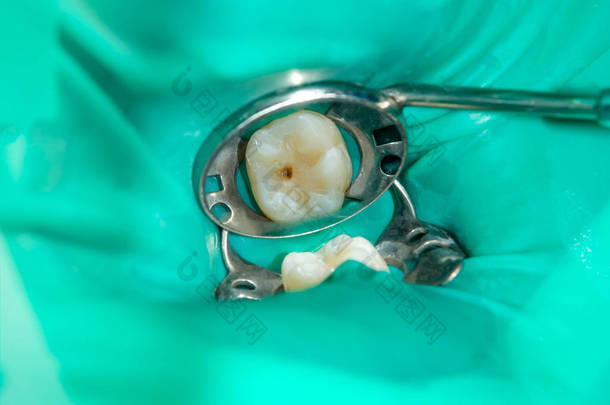 在牙科诊所的治疗阶段, 一个人腐烂的龋齿牙齿的特写。橡胶坝系统与乳胶围巾和金属夹的使用, photopolymeric 复合填料的生产