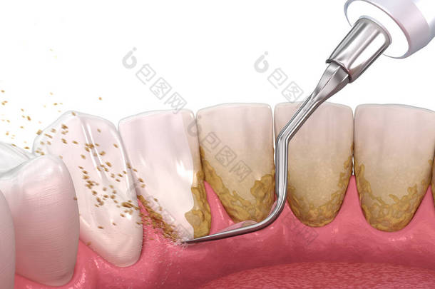 口腔卫生：烫伤和根部修整（常规牙周病治疗） 。医学上准确的人类牙齿治疗三维图像