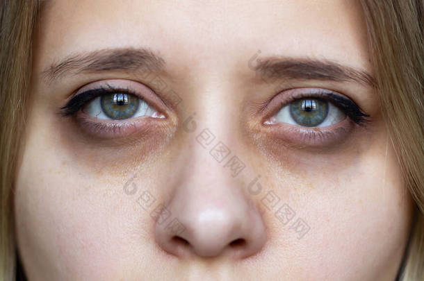 拍了一张年轻女性的脸绿眼睛，眼睛下面有黑眼圈。眼睛下面的伤痕是疲劳、紧张、睡眠不足、失眠和压力造成的