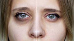 用化妆品把年轻女性的脸剪下来的照片女性绿色眼睛，在化妆品治疗前后眼睛下方有瘀伤。黑眼圈下