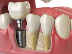 人 dentu 牙牙种植体的解剖学研究