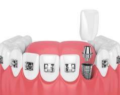 3d. 用正畸大括号和牙科植入物进行牙齿渲染。正畸大括号概念