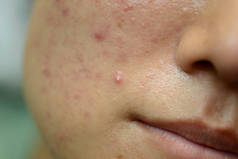 Young Asian woman showing her face with acne and moles
