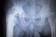 X 射线髋关节人类骨骼的骨科扫描的图像