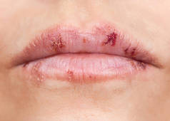 嘴唇上有多种疱疹, 以疮的形式出现.