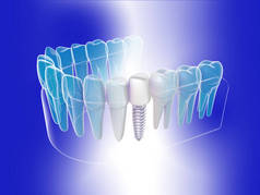 3D的图形，等距风格的牙齿植入物的说明。蓝色背景透明义齿的解剖学图像.