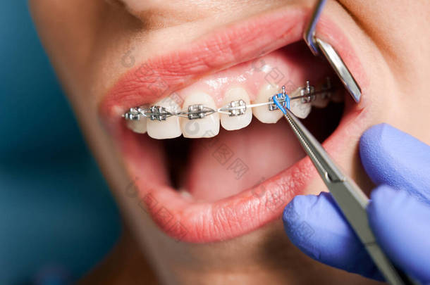 在诊所接受牙科矫正器治疗的妇女的近视。牙齿矫正医生使用牙镜和钳，同时在病人的牙齿上戴上正牙托。牙科的概念.
