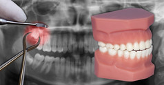 在牙科扫描手术提取仿真应用