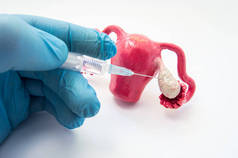 穿刺鸡蛋生产、 处理或卵巢刺激 （排卵） 在体外受精或妇科照片概念程序。医生刺刺激卵巢的解剖模型或治疗