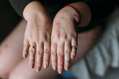 许多人的问题-手上的湿疹。女人的手