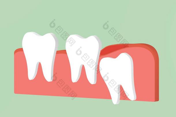 智齿 (角或内侧嵌塞) 与炎症对其他牙齿的影响-牙科卡通3d 渲染平面风格设计的<strong>可爱字</strong>符
