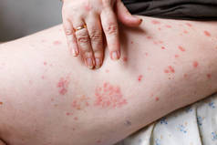特写的妇女发痒和搔银屑病斑点手工。皮肤上的牛皮癣或湿疹。过敏性皮肤红点