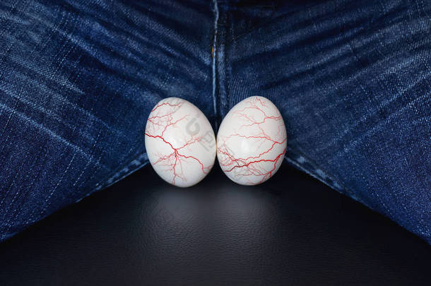 白蛋--人的球的象征。精索静脉曲张-男性疾病导致男性<strong>不孕</strong>。危险泌尿系统疾病的概念。睾丸上的静脉曲张.