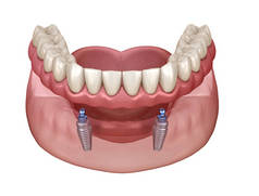下颌骨可摘除假肢全部在2个系统上，由带有球状附着物的植入物支撑。医学上准确的牙科3D图像