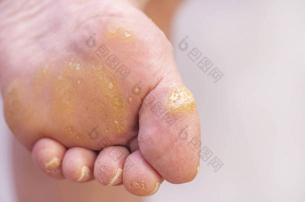 女人的脚上有花纹和玉米粒。 皮肤科疾病。 花生酱疣。 在与皮肤科医生的预约中。 浅<strong>色底纹</strong>的雌性脚.