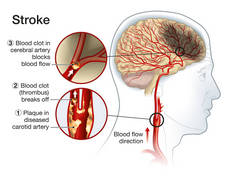 显示颈动脉斑块、血凝块破裂及血流阻塞的图例