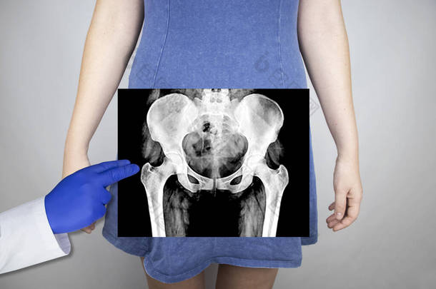一个女人骨盆的X<strong>光照片</strong>放射学家检查X<strong>光</strong>检查。髋关节的<strong>照片</strong>被贴在病人的身体上.
