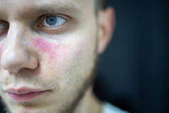 面部皮肤红肿的年龄点，一个年轻人是病的系统性红斑狼疮