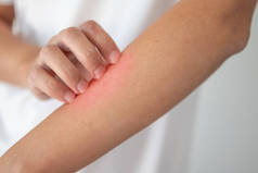 男子因皮肤湿疹性皮炎在手臂上的瘙痒及划伤