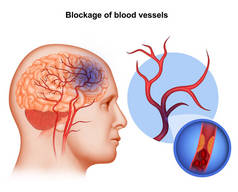 脑动脉阻塞的医学说明