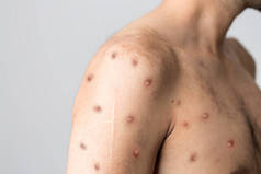 猴痘是一种危害世界的新疾病.高质量的照片