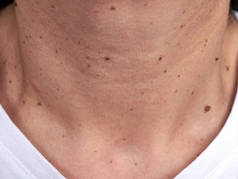 一个女人的脖子上有许多小痣和疣子，没有露出脸，靠得很近