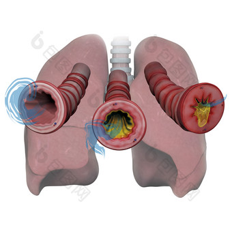 肺细支气管炎症示例插图