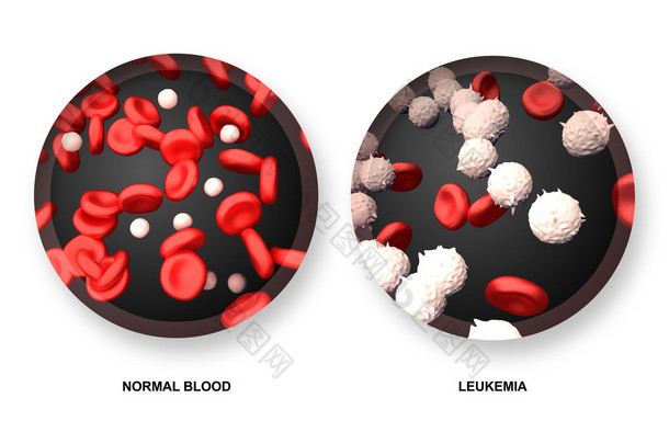 白血病 vs 正常的<strong>血液</strong>