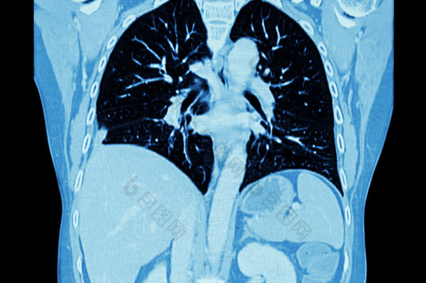 肺癌 （胸部和腹部 Ct 扫描 ： 显示右肺癌 ） （ 冠状平面 )