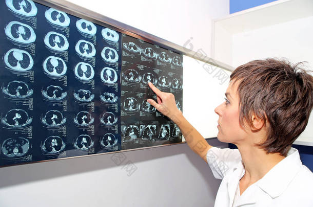  Ct （计算机断层扫描） 的肺，肺栓塞 (Pe)