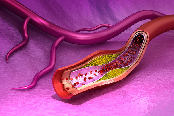 胆固醇斑块的血管，医学上准确的 3d 图