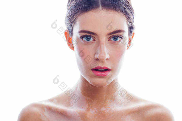 beautiful young brunette woman with vitiligo disease isolated on white positive smiling, model probl