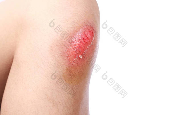 亚洲男孩在足球比赛中膝盖受伤, 意外受伤。在白色背景上隔离的奔跑事故后刮除的出血的关闭.