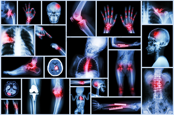 集合 x 射线多个人体器官 & 骨科手术与多个疾病 (肺结核，痛风，类风湿关节炎、 颈椎病、 骨折骨，中风、 脑肿瘤等)