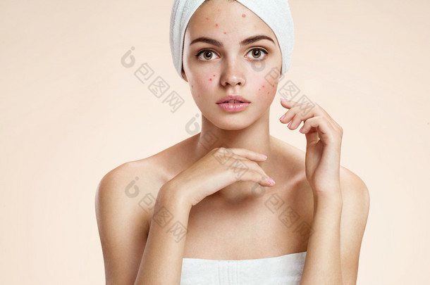 在休克的她用一条毛巾在她头上的粉刺的忧郁女孩。女人的皮肤护理概念