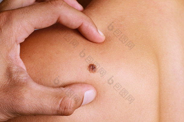 Doctor , Dermatologist, hands examines a birthmark of patient. Checking benign moles