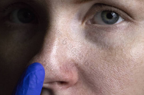 一个年轻女子鼻子上的割草病。痤疮在脸上。由医生进行检查