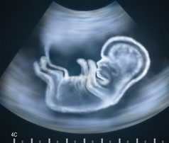 婴儿在母亲的子宫中的超声图像
