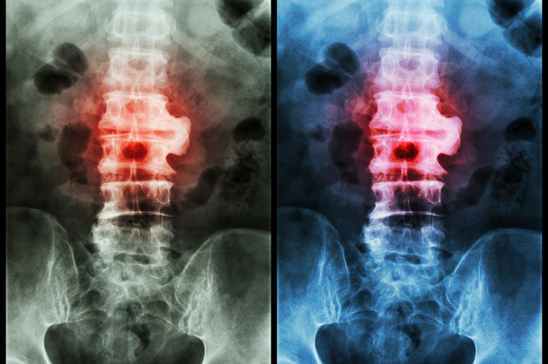 脊柱炎 （薄膜 X 射线腰椎 - 阴囊脊柱 ： 在 L2-3 显示脊柱炎 )
