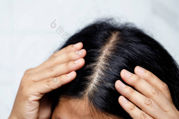 一个脱发的<strong>女人</strong>，对洗发水和护发素过敏.