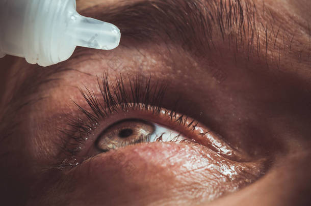 一个男人用鲜红的动脉滴开人眼，以改善视力。<strong>刺激</strong>和红眼。学生，虹膜，睫毛在宏观。视力问题