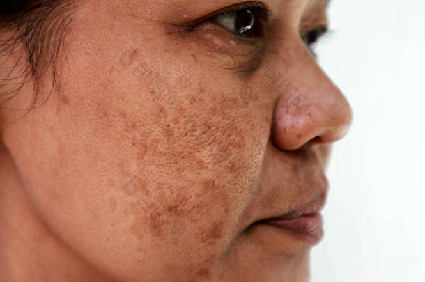 皮肤问题， 特写皮肤面对亚洲<strong>妇女</strong>与斑点黑色素瘤.