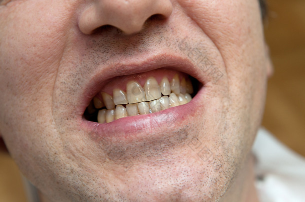 有黄色牙齿的人烟草概念的害处.