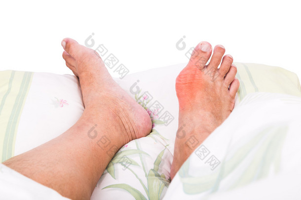 右脚搁在床上痛苦的肿胀的痛风炎症