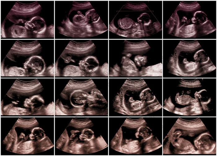 超声胎儿图片拼贴