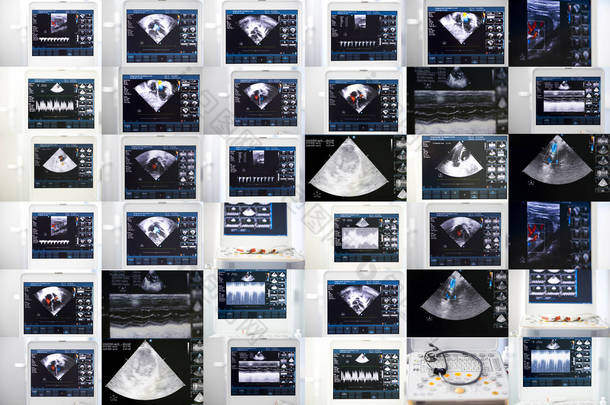 超音波机图像拼贴